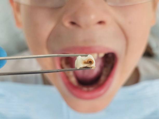 Best Emergency Dental Care for Broken or Chipped Teeth in Central City, IA